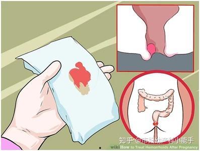 吃小瓜痔疮痛,揭秘痔疮困扰与缓解之道