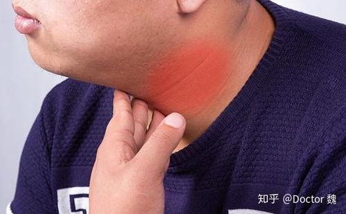 角瓜甲亢可以吃吗,适宜与禁忌一览